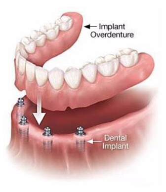 Implantgraphic