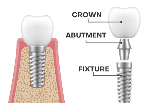 Dental Implant