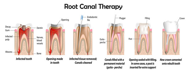 Root Canal Therapy