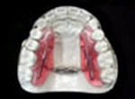 Inman Aligner Wraparound